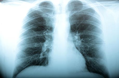 Zebra Medical Receives FDA Clearance for Automated Chest X-Ray Analysis Algorithm