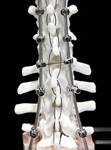 מערכת לבדיקת עמוד שדרה של מדטרוניק