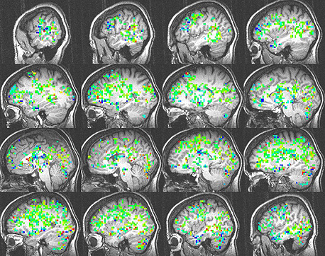 הדמיית המוח של סקאל בעת הניסוי. עוד ועוד חלקים במוח מצטרפים, וברגע האורגזמה (צד שמאל למטה) נרשמה פעילות ביותר מ-30 אזורים