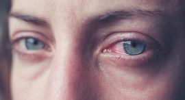 Eye irritation (illustration)