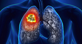 Cancer tumor (illustration). Photo: medscape