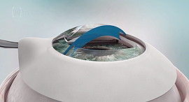 CorNeat Vision illustration. Photo: CorNeat Vision