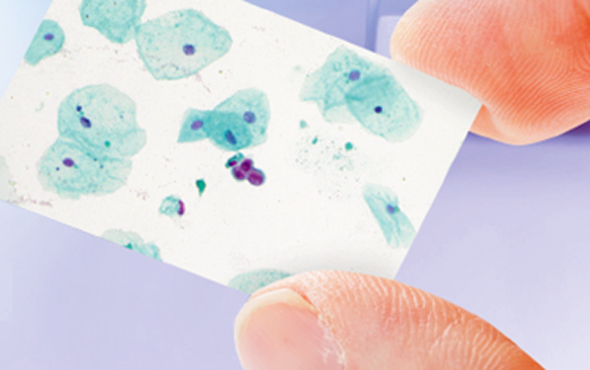 זיהוי תאי סרטן באמצעות טכנולוגיית סל-דיטקט של מיקרומדיק, צילום: יח"צ