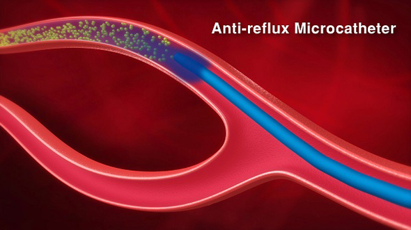 Anti-reflux microcatheter (illustration). Photo: Accurate Medical Therapeutics Ltd.