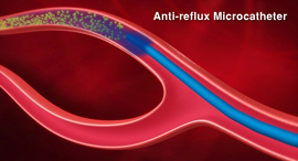 Anti-reflux microcatheter (illustration). Photo: Accurate Medical Therapeutics Ltd.