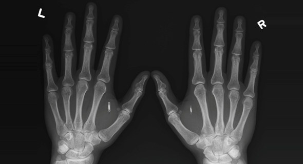 צ'יפים בכף היד צילום רנטגן