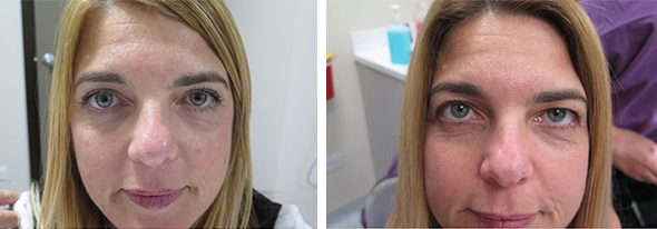 דינה אבוזגלו לפני הניתוח (מימין) ואחריו (משמאל), צילום: המרכז הרפואי עין טל