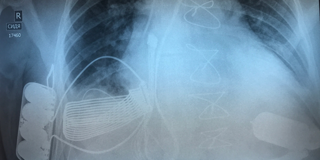 Wireless Heart Pump Technology Implanted in a Patient for the First Time