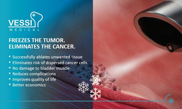 וסי מדיקל – מקפיאים את הגידול. מחסלים את הסרטן , קרדיט: Vessi Medical