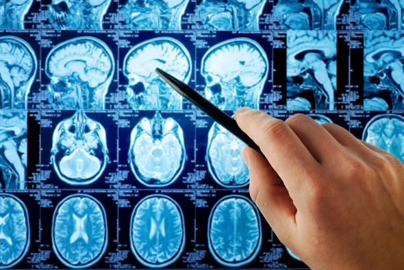 Diagnosing mental health conditions can be difficult as the brain is a very complex organ. Photo: Shutterstock