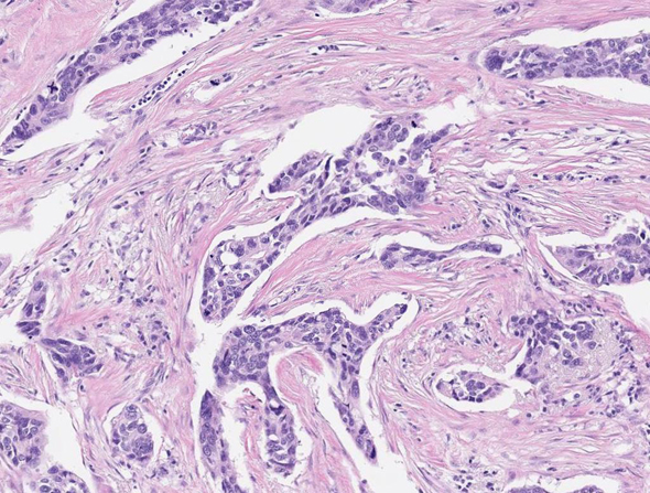 Cancerous cells (colored in dark purple) are visible in this slide using Nucleai&#39;s platform. Photo: Nucleai