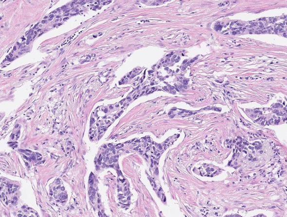 Cancerous cells (colored in dark purple) are visible in this slide using Nucleai