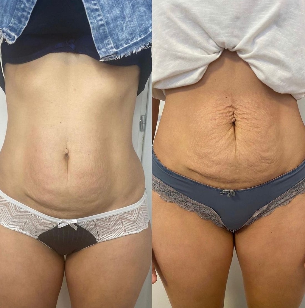לפני ואחרי טיפול אסתטי בבטן