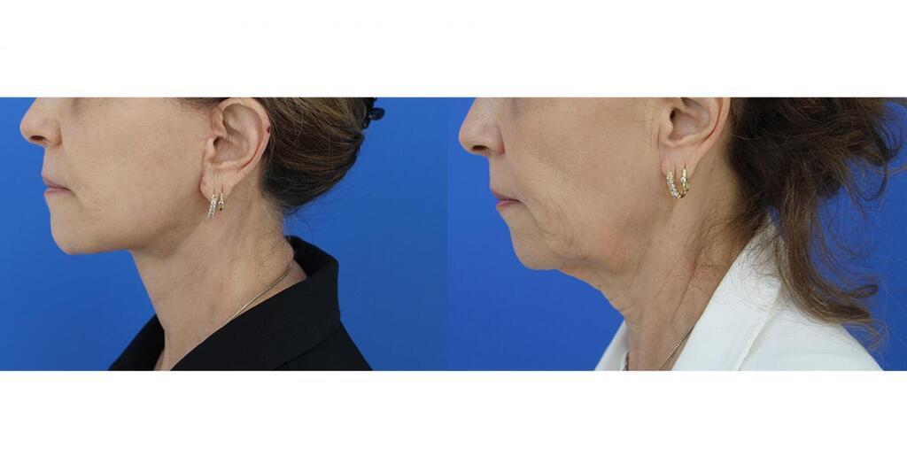 ד"ר ליאור לייבו - מתיחת פנים | תמונה לפני ואחרי