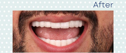  Fly Dent- השתלות שיניים וניתוחים אסתטיים, Fly Dent