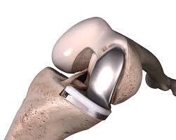 הדמיה של החלפה חלקית של הברך (צילום: באדיבות ד"ר נביל גרייב) הדמיה של החלפה חלקית של הברך