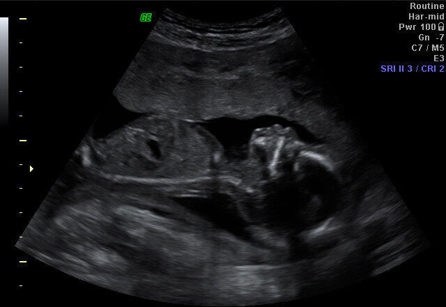 התיעוד הראשון מההריון הראשון, הרגע שבו בישרו לנו שיש לנו בן. למה השכנים החרדים שלי לא חיים עם החרדה התמידית שנולדת ברגע הזה?